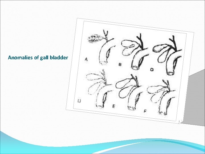 Anomalies of gall bladder 