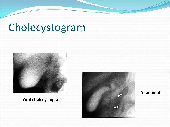 Cholecystogram After meal Oral cholecystogram 