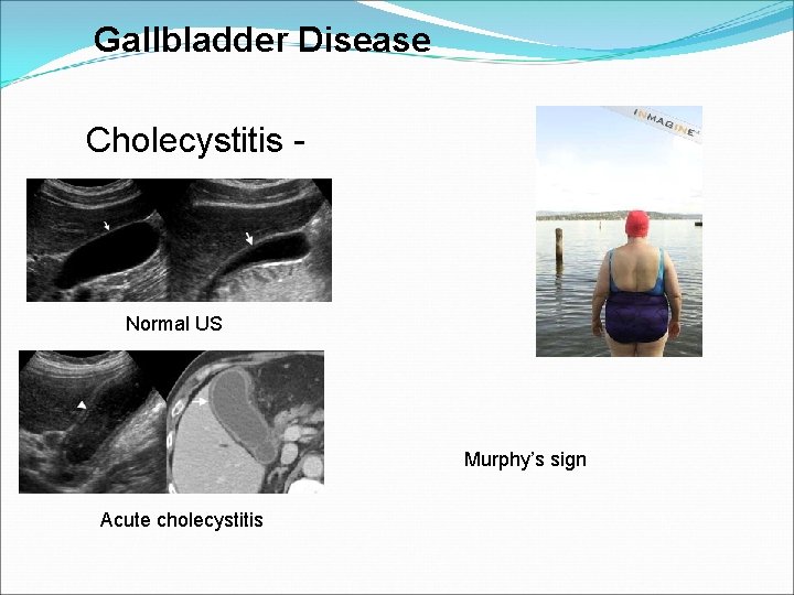 Gallbladder Disease Cholecystitis - Normal US Murphy’s sign Acute cholecystitis 