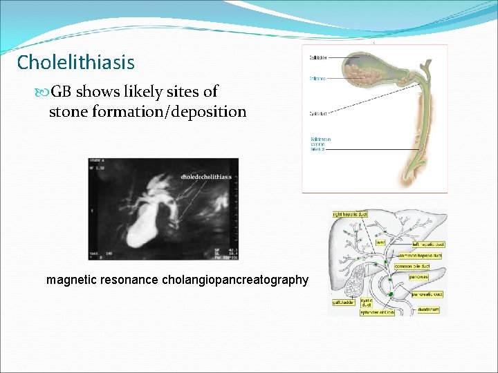 Cholelithiasis GB shows likely sites of stone formation/deposition magnetic resonance cholangiopancreatography 