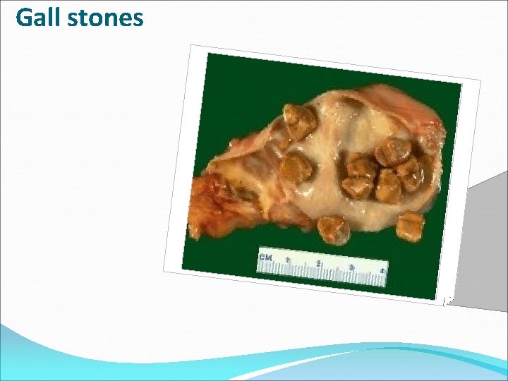 Gall stones 