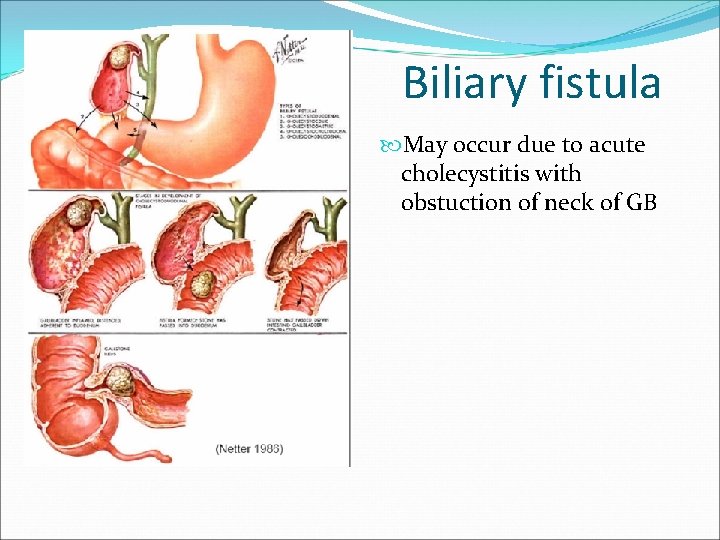 Biliary fistula May occur due to acute cholecystitis with obstuction of neck of GB