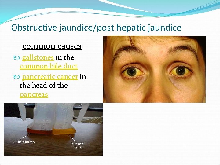 Obstructive jaundice/post hepatic jaundice common causes gallstones in the common bile duct pancreatic cancer