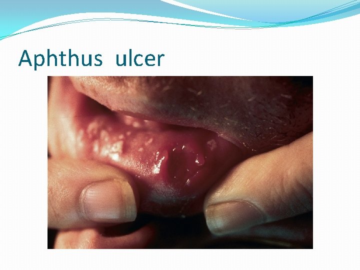 Aphthus ulcer 