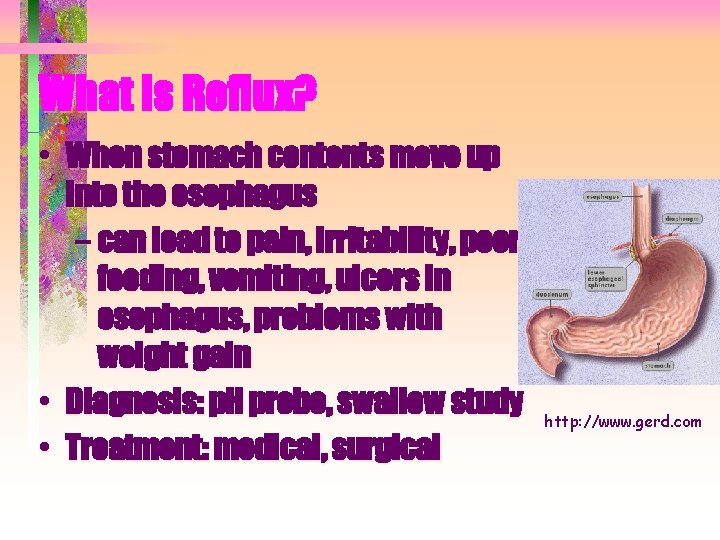 What is Reflux? • When stomach contents move up into the esophagus – can What is Reflux? • When stomach contents move up into the esophagus – can