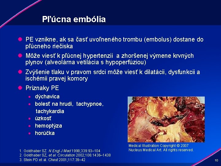 Pľúcna embólia ® PE vznikne, ak sa časť uvoľneného trombu (embolus) dostane do pľúcneho