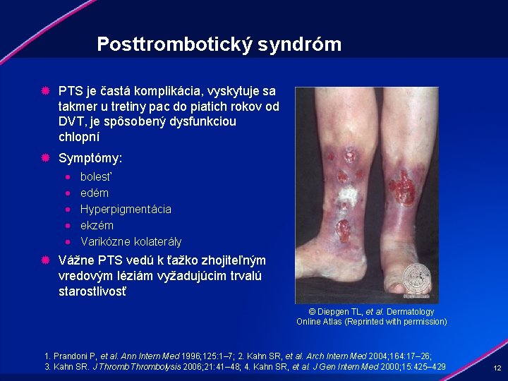 Posttrombotický syndróm ® PTS je častá komplikácia, vyskytuje sa takmer u tretiny pac do