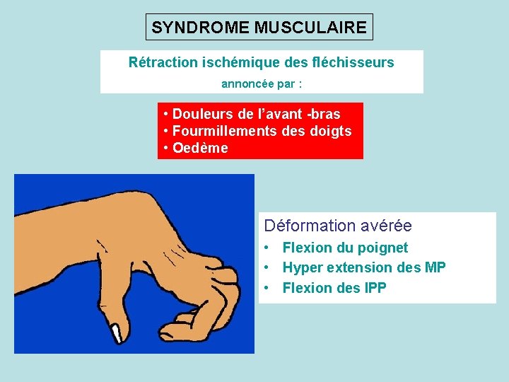 SYNDROME MUSCULAIRE Rétraction ischémique des fléchisseurs annoncée par : • Douleurs de l’avant -bras