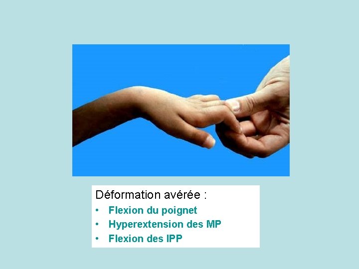 Déformation avérée : • Flexion du poignet • Hyperextension des MP • Flexion des