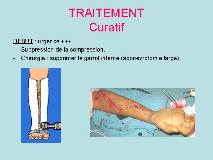 TRAITEMENT Curatif DEBUT : urgence +++ - Suppression de la compression. - Chirurgie :