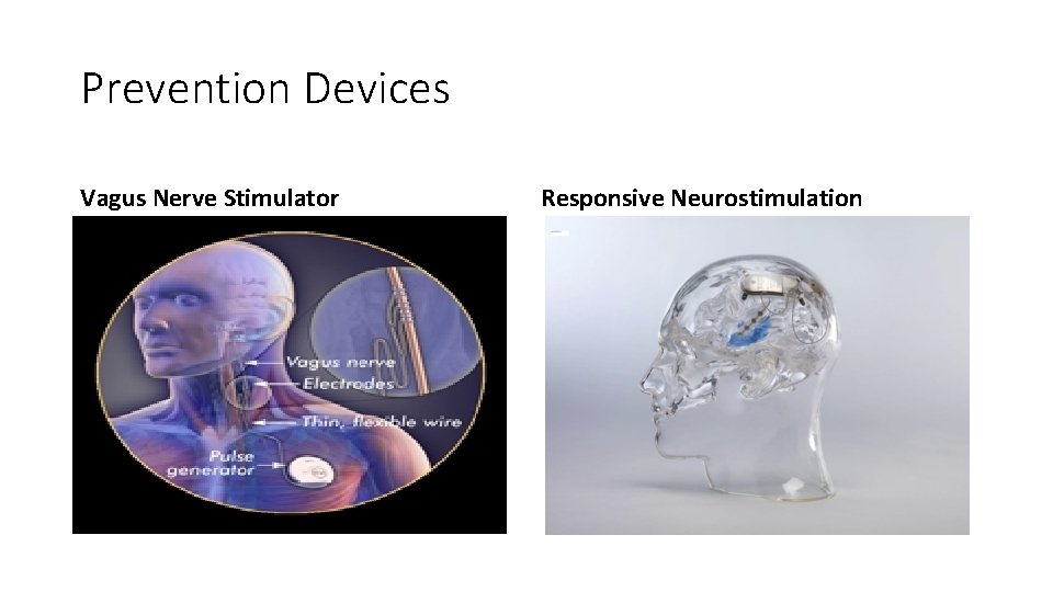 Prevention Devices Vagus Nerve Stimulator Responsive Neurostimulation 