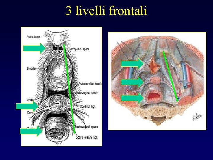 3 livelli frontali 