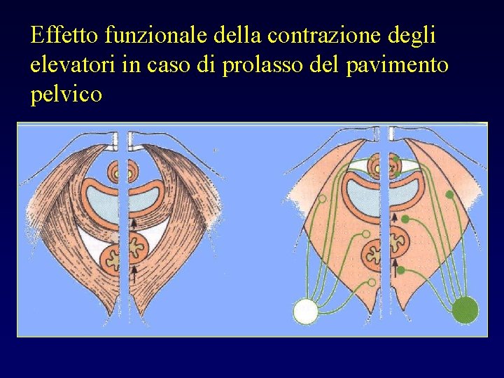 Effetto funzionale della contrazione degli elevatori in caso di prolasso del pavimento pelvico 