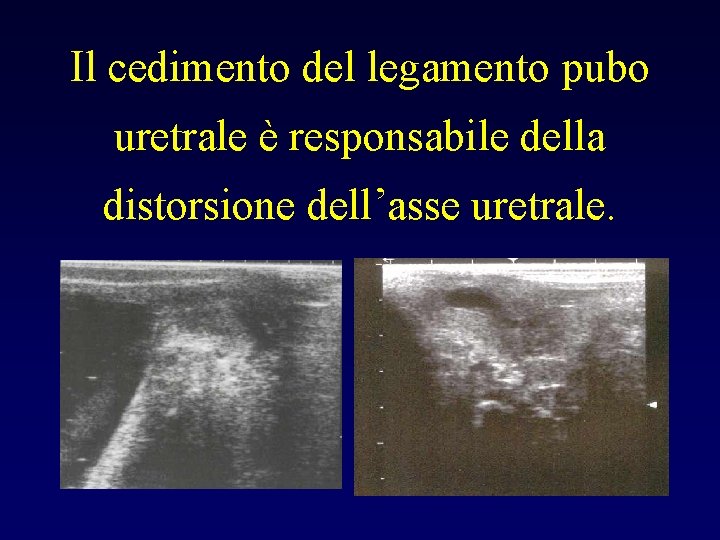 Il cedimento del legamento pubo uretrale è responsabile della distorsione dell’asse uretrale. 