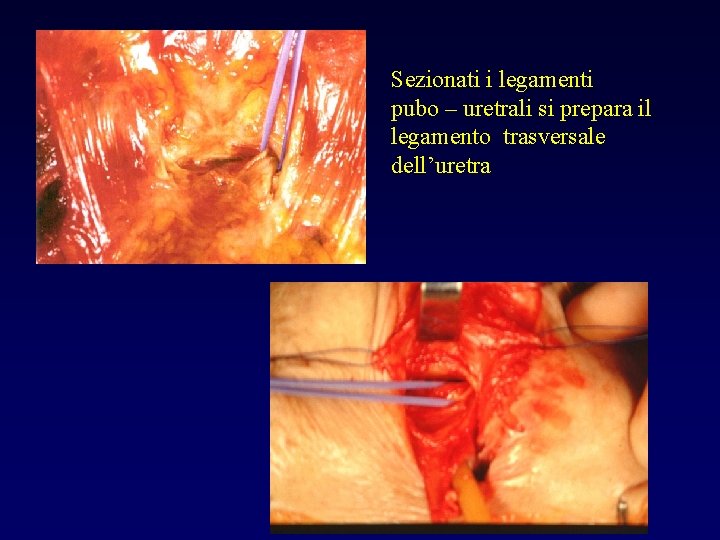 Sezionati i legamenti pubo – uretrali si prepara il legamento trasversale dell’uretra 