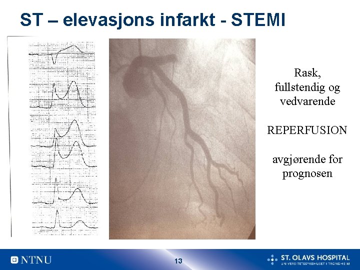 ST – elevasjons infarkt - STEMI Rask, fullstendig og vedvarende REPERFUSION avgjørende for prognosen