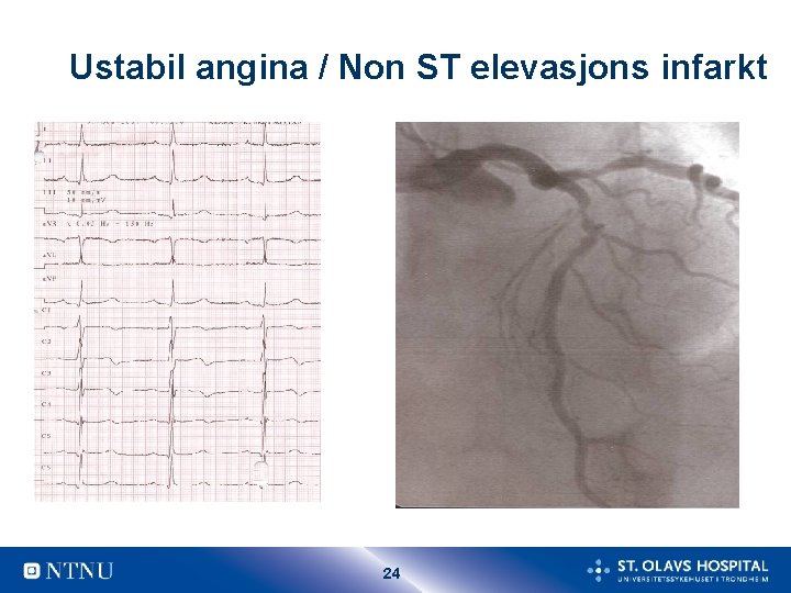 Ustabil angina / Non ST elevasjons infarkt 24 