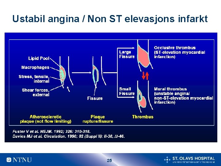 Ustabil angina / Non ST elevasjons infarkt 25 