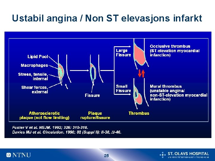 Ustabil angina / Non ST elevasjons infarkt 25 Ustabil angina / Non ST elevasjons infarkt 25