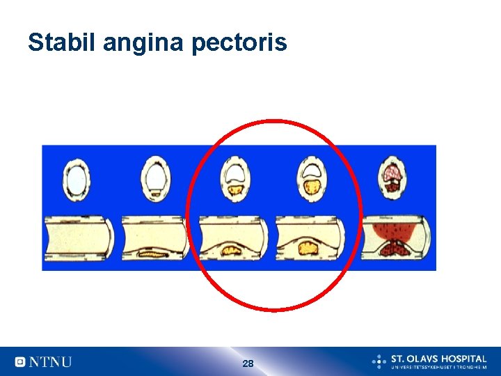 Stabil angina pectoris 28 