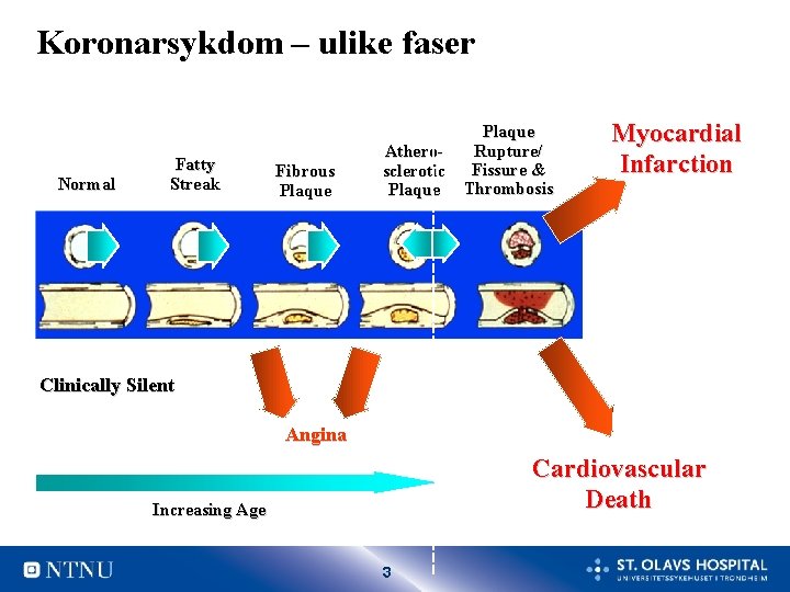 Koronarsykdom – ulike faser Normal Fatty Streak Fibrous Plaque Atherosclerotic Plaque Rupture/ Fissure &