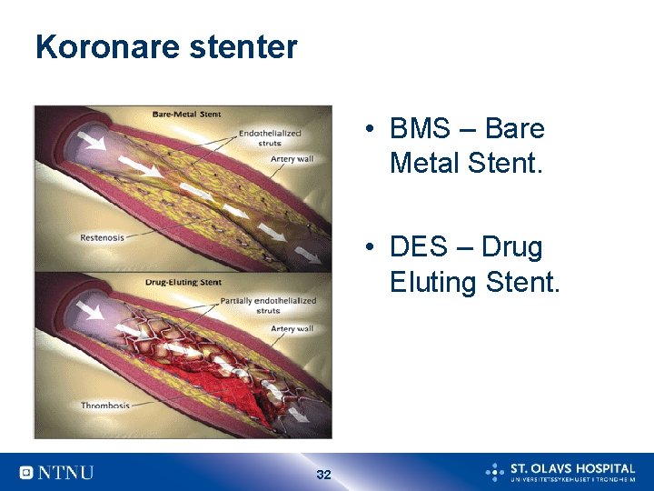 Koronare stenter • BMS – Bare Metal Stent. • DES – Drug Eluting Stent.