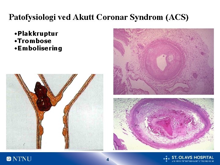 Patofysiologi ved Akutt Coronar Syndrom (ACS) • Plakkruptur • Trombose • Embolisering 4 