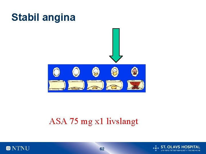 Stabil angina ASA 75 mg x 1 livslangt 62 