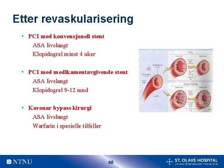 Etter revaskularisering • PCI med konvensjonell stent ASA livslangt Klopidogrel minst 4 uker • Etter revaskularisering • PCI med konvensjonell stent ASA livslangt Klopidogrel minst 4 uker •