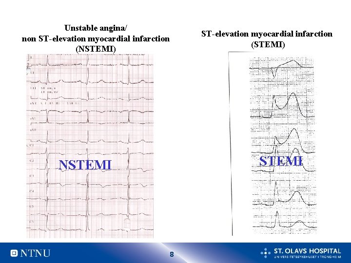 Unstable angina/ non ST-elevation myocardial infarction (NSTEMI) ST-elevation myocardial infarction (STEMI) STEMI NSTEMI 8