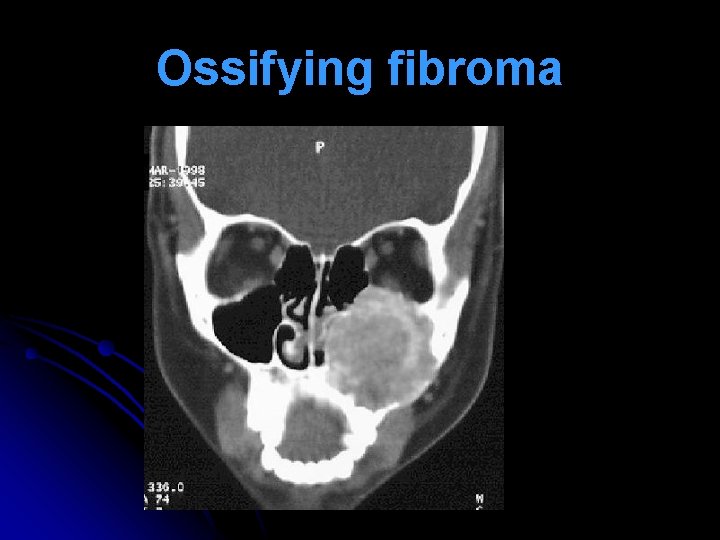 Ossifying fibroma 