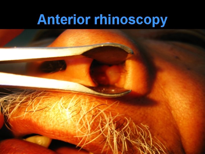 Anterior rhinoscopy 