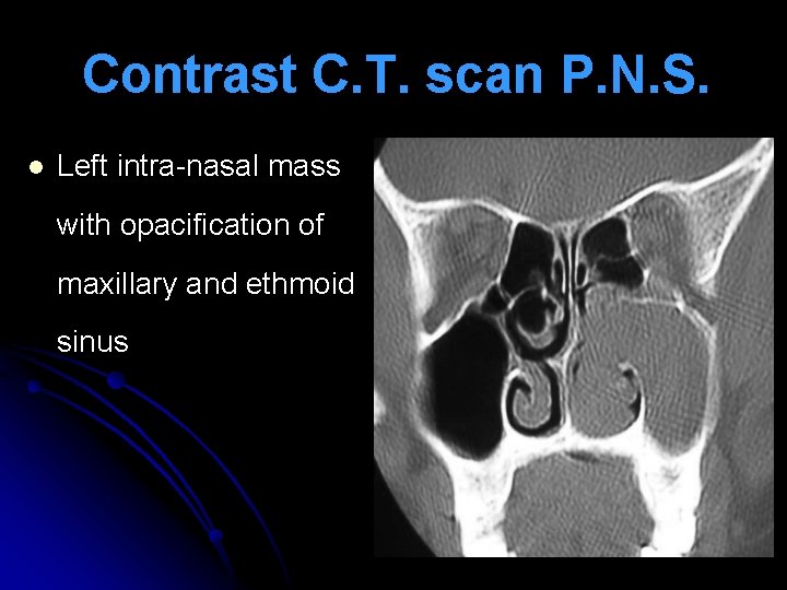 Contrast C. T. scan P. N. S. l Left intra-nasal mass with opacification of