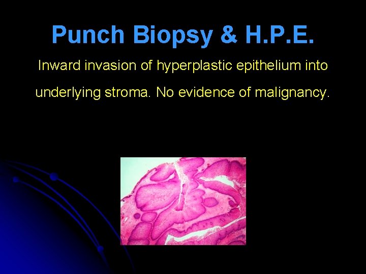 Punch Biopsy & H. P. E. Inward invasion of hyperplastic epithelium into underlying stroma.