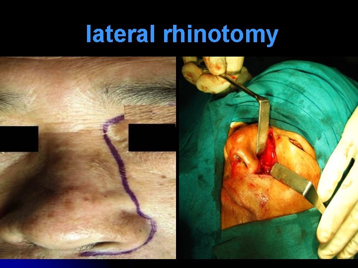 lateral rhinotomy 