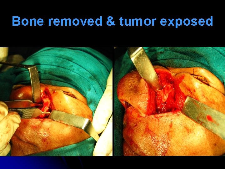 Bone removed & tumor exposed 