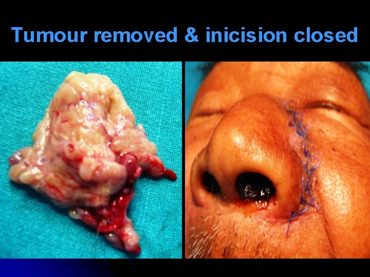 Tumour removed & inicision closed 