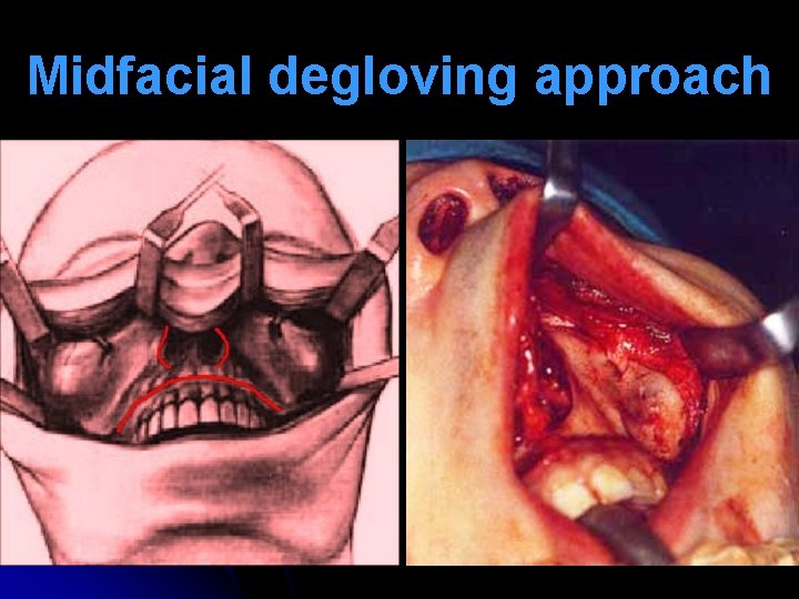 Midfacial degloving approach 