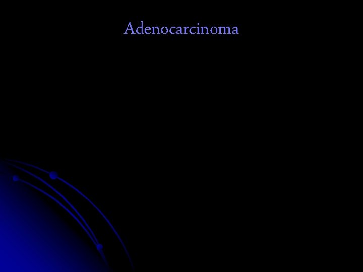 Adenocarcinoma 