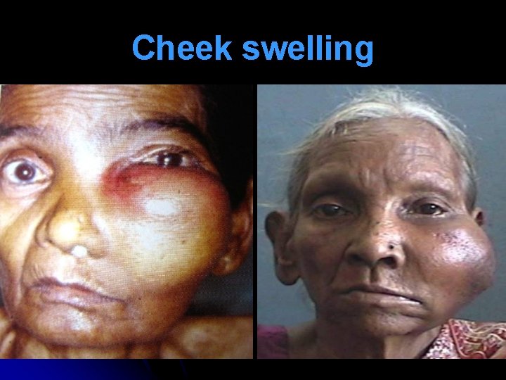 Cheek swelling 