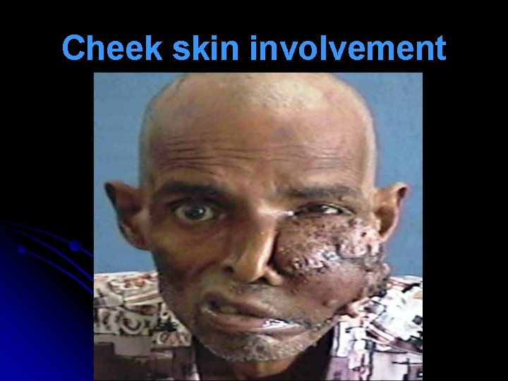 Cheek skin involvement 