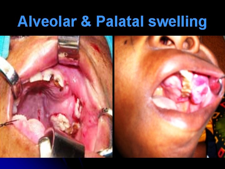 Alveolar & Palatal swelling 