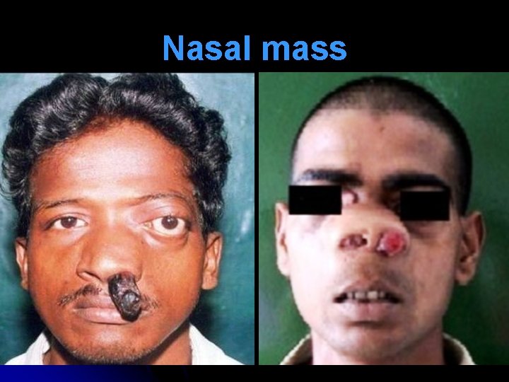 Nasal mass 