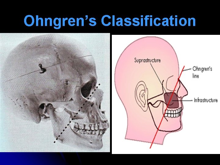 Ohngren’s Classification 