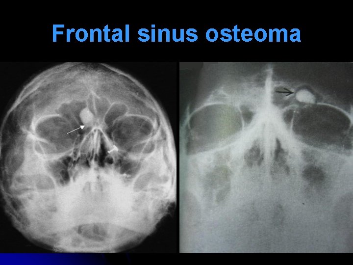 Frontal sinus osteoma 