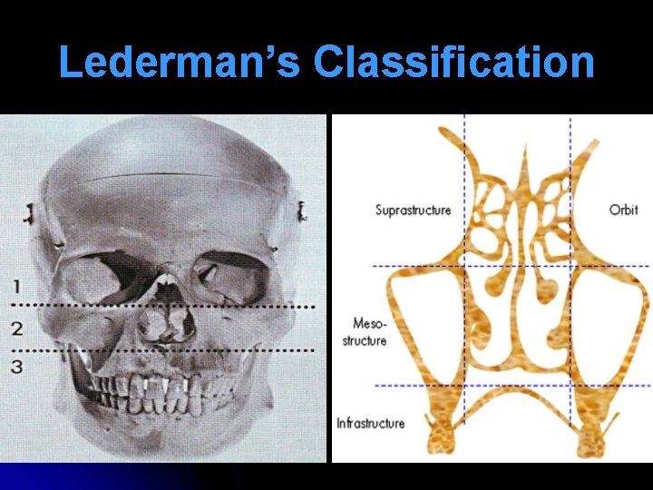 Lederman’s Classification 