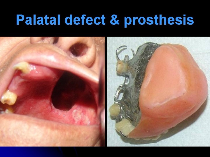 Palatal defect & prosthesis 