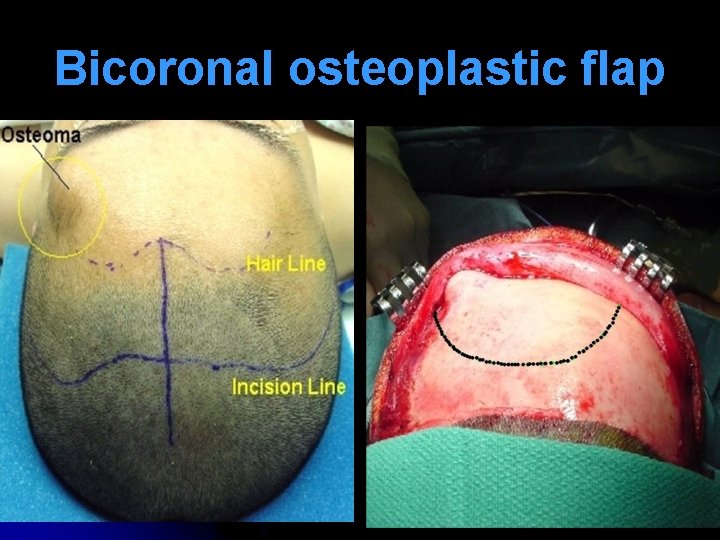 Bicoronal osteoplastic flap 