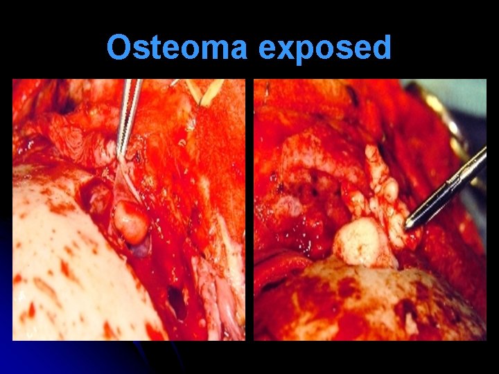 Osteoma exposed 