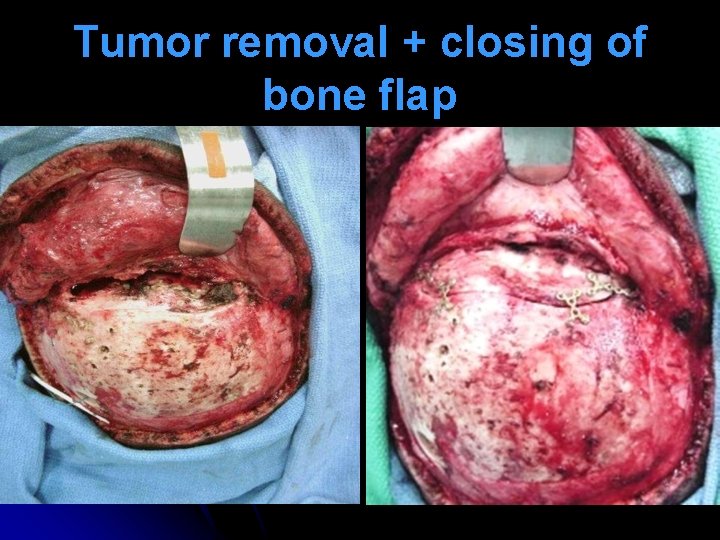 Tumor removal + closing of bone flap 